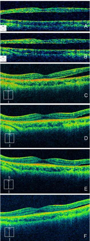 Fig. 3 Arteriovenous phase fluorescein angiogram of the left eye optic disc pit (red arrow), showing no leakage from the optic disc pit