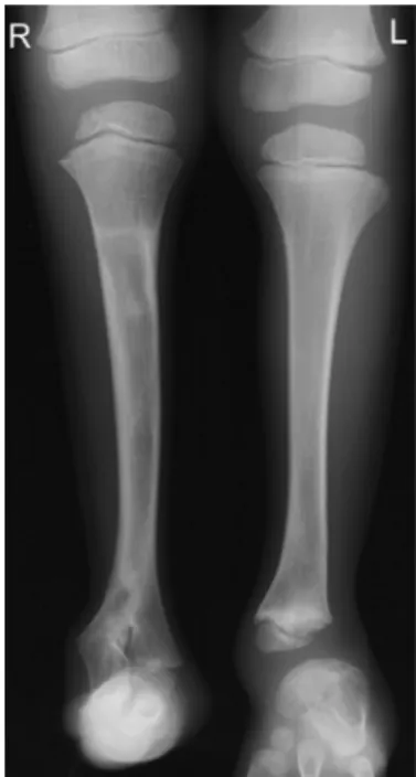 Abbildung 2 A.p. Röntgenbild des  Patienten im Alter von  6 Jahren. Der Rückfuß  steht zur Längsachse der  Tibia nach lateral  ver-schoben.