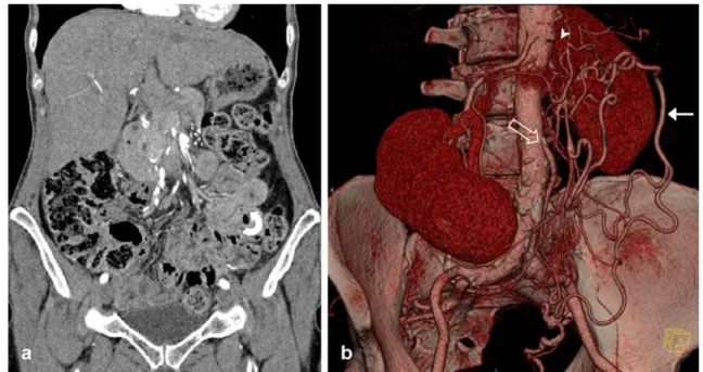 Fig. 9 Ischaemic bowel disease secondary to generalised arterio- arterio-sclerosis in a 64-year-old woman with severe diffuse abdominal pain