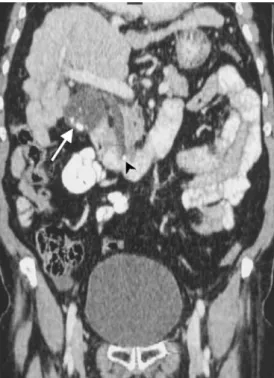 Fig. 3 Acute appendicitis and walled-off perforation in a 30-year- 30-year-old man with fever, elevated white blood cell count, and acute abdominal pain in the RLQ