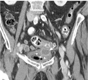 Fig. 4 Meckel’s diverticulitis in a 48-year-old man with acute abdominal pain in the RLQ