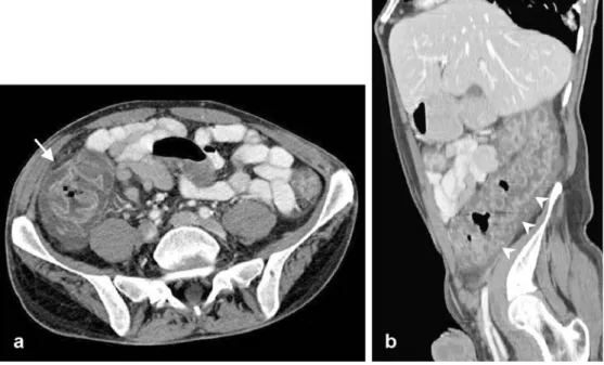 Fig. 6 Pseudomembranous colitis in a 44-year-old man on antibiotics because of meningitis and with acute abdominal pain in the lower abdomen