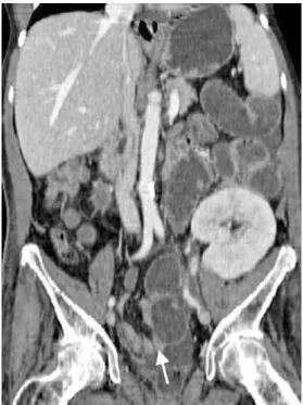 Fig. 7 Adhesive small bowel obstruction in a 43-year-old woman with diffuse acute abdominal pain and a history of kidney  trans-plantation 1 year previously and surgery for anal carcinoma 6 weeks previously