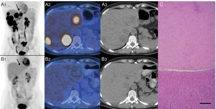 Table 3 TRG versus FDG PET/CT Cut off for dSUV