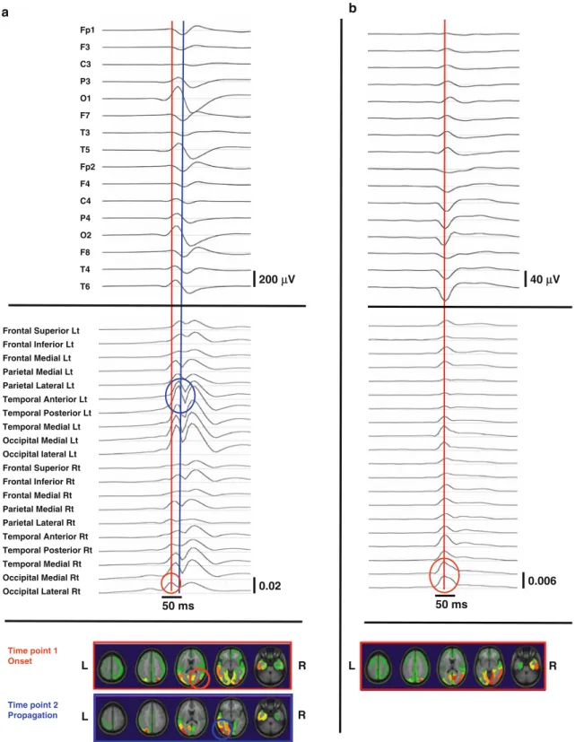 Fig. 2 Results in Patient 6 who is considered optimally treated with LEV. Upper part: Raw EEG against a common reference