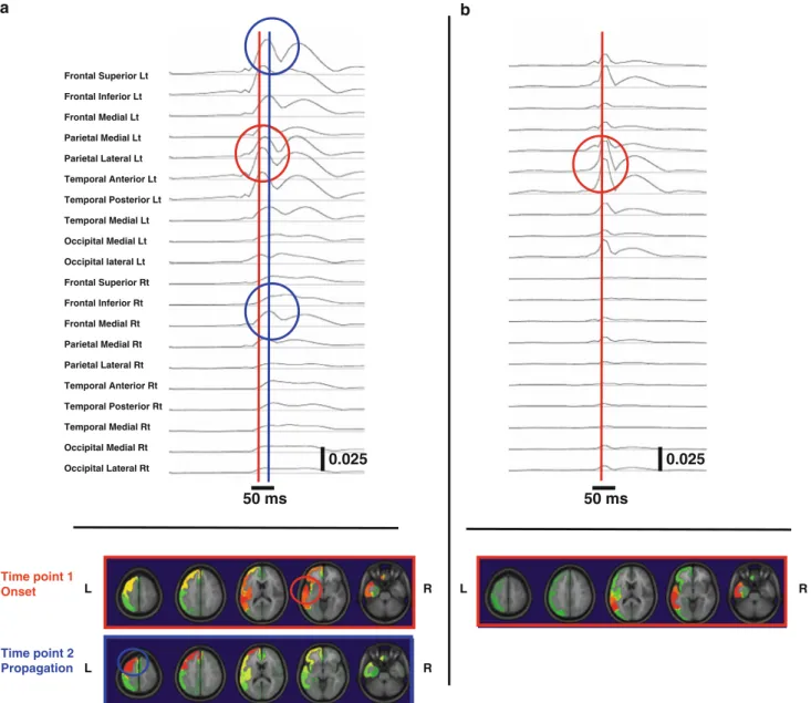 Fig. 3 Results in Patient 12. Upper part: Time course of the reconstructed cortical activation in the 20 ROIs