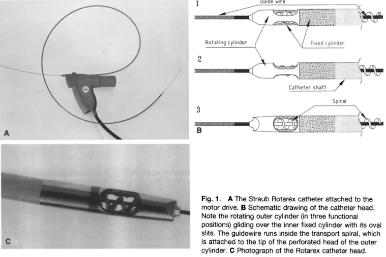 Fig.  1.  A  The  Straub  Rotarex  catheter  attached  to  the  motor  drive.  B  Schematic  drawing  of the  catheter  head