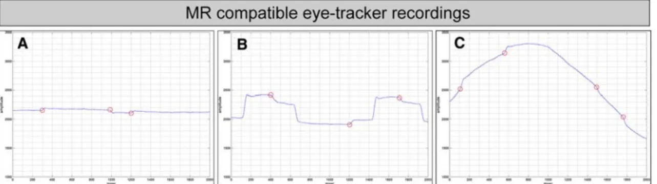 Figure 1 illustrates an example of eye-tracker recording and corrective saccades during Wxation (A), pro-saccades (B) and pursuit (C).