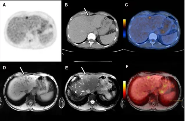 Fig. 3 Enhanced lesion detection with contrast-enhanced PET/CT ? MRI in liver lesions