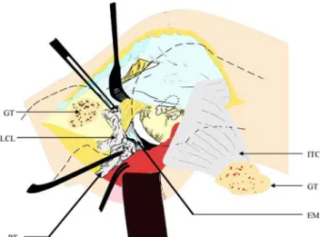 Fig. 3 Vertical incision of lateral capsule, in this acute injury revealed the ruptured popliteal tendon (PT) and lateral collateral ligament (LCL)