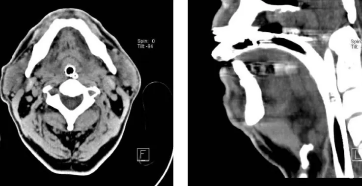 Fig. 1 (a) transaxial CT at the level of the base of the tongue shows diffuse swelling of the mouth floor, base of the tongue and oropharynx
