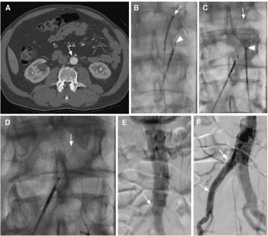 Fig. 1 Sixty year old male patient with acute thoracico-abdominal type B dissection, clinically presented with acute ischemia of the right leg