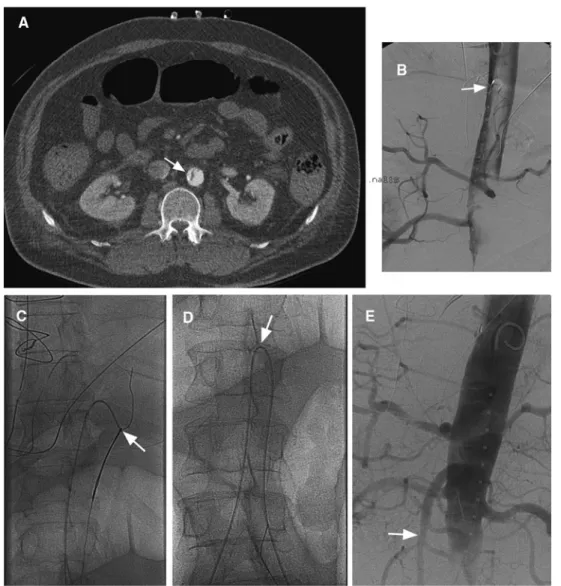 Fig. 3 Seventy year old male patient 1 day after aorto-coronary bypass surgery with iatrogenic type A dissection necessitating operative hemi-arch reconstruction