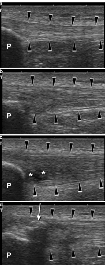 Fig. 2 Sagittal sonograms of patellar tendons ( black arrowheads ):