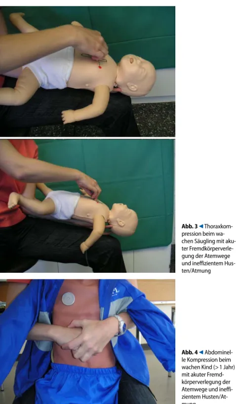 Abb. 3  9  Thoraxkom- Thoraxkom-pression beim  wa-chen Säugling mit  aku-ter  Fremdkörperverle-gung der Atemwege  und ineffizientem  Hus-ten/Atmung