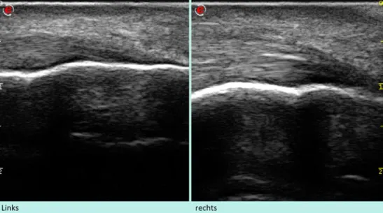 Abb. 2  8  Rechte Achillessehne im Graustufenbild ödematös verdickt, hyperechogene streifenförmige Echotextur-  Rechte Achillessehne im Graustufenbild ödematös verdickt, hyperechogene streifenförmige Echotextur-störung, Kortikalis intakt