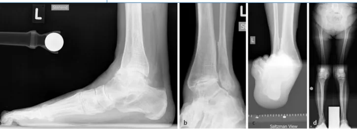 Abb. 2  8  Posttraumatische Valgus-OSG-Arthrose. Die 69-jährige Patientin zog sich einige Jahre zuvor eine in Fehlstellung ver-  Posttraumatische Valgus-OSG-Arthrose. Die 69-jährige Patientin zog sich einige Jahre zuvor eine in Fehlstellung ver-heilte Mall