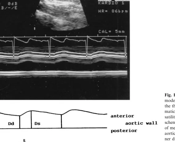 Fig. 1. (Top) Example of an M- M-mode echocardiographic image of the thoracic aorta at the  diaphrag-matic level: shown is the aortic  pul-satility in a normal child