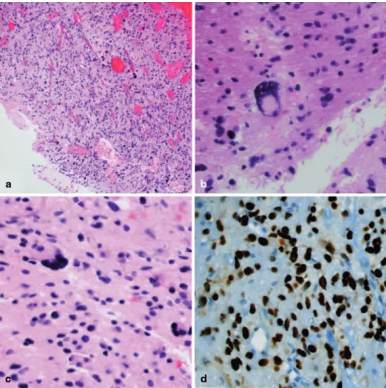 Fig. 2  (a) Histologically the  brain biopsy showed a cellular,  mitotically active glial tumor  (a: original magnification x40)  and (b, c) bizarre, occasionally  multinucleated giant tumor cells  were also seen