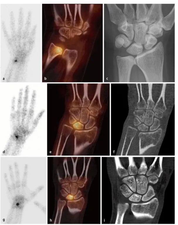 Abb. 1  9  a–c DRUG-Ar-  a–c DRUG-Ar- throse mit vermehrter Ra-dionuklidanreicherung  in der Ulna distal; planare   Szintigraphie, Spätaufnah-me (a); SPECT/CT koronal   (b); konventionelles Rönt- gen a.-p. (c). d–f Ulnokar-pales Impaktionssyndrom,   vermeh