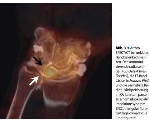 Abb. 3  9  Arthro-  Arthro-SPECT/CT bei unklaren   Handgelenkschmer- zen. Der kommuni- zierende radialseiti- ge TFCC-Defekt (wei-ßer  Pfeil), die LT-Band-Läsion (schwarzer Pfeil)   und die vermehrte Ra-dionuklidspeicherung  im Os lunatum passen  zu einem u