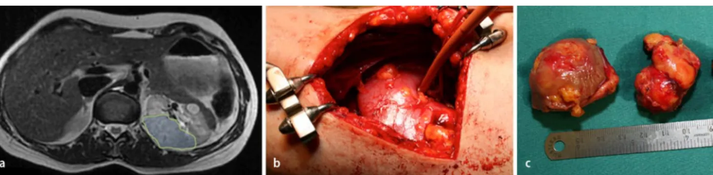 Abb. 2  8  Zwei Angiomyolipome in der linken Niere auf dem Magnetresonanzschnittbild (a), im Operationssitus (b) sowie nach  deren chirurgischer Entfernung (c). Die Patientin erfüllte die klinischen Diagnosekriterien nach Gomez für die tuberöse Sklerose