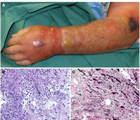 Fig. 1 a Left arm with erythematous, partially necrotic skin and hemorrhagic bullae, b periodic acid–Schiff stain (940) of skin biopsy showing an encapsulated yeast (arrow), c multiple encapsulated yeasts on Grocott stain (940) of a tissue specimen