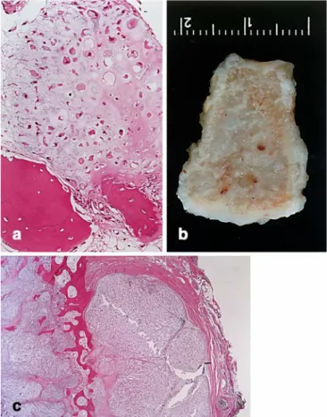 Fig. 2 a The first curettage shows confluent lobules of neoplastic cartilage with loss of grouping of markedly atypical chondrocytes.