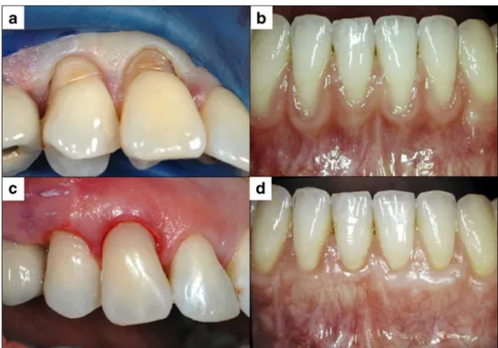Fig. 2 Restitution of the anatomy of the cervically exposed dentin using a restorative approach with an adhesive class V filling (a/c), thereby covering and protecting the sensitive dentin