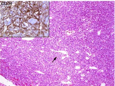 Fig. 4 Cut surface of the solitary fibrous tumor of the second patient