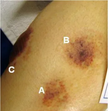 Fig. 1 Skin lesions on the patient’s left leg at different stages of development. a Skin lesion minutes after initial appearance