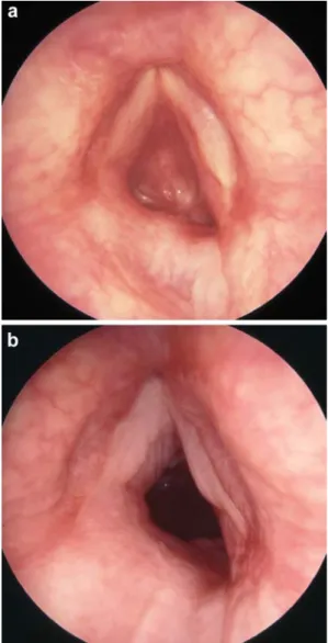 Fig. 3 Preoperative and postoperative views of a grade IV subglottic stenosis secondary to external laryngeal trauma in a 28-year-old man