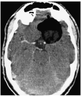 Fig. 2 One-year follow-up MRI (T2-WI) of Patient 1 with CSF-filled resection site and left subdural hygroma; no tumour rest or spilled components