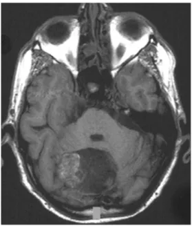 Fig. 5 Axial MRI (T2-WI) with hyperintensity of infratentorial dermoid with severe mass effect and compression of the 4th ventricle (Patient 4)