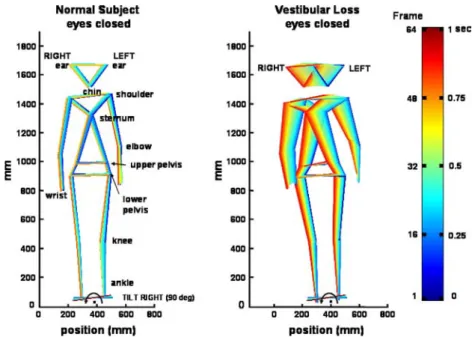 Fig. 7 Stick  Wgure representatives of body segment movements to right tilt of the support-surface in a typical VL and control subject  un-der eyes closed conditions