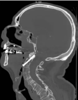 Fig. 3 Case 3: fall down stairs. Odontoid fracture type II after surgical treatment. The screw is in a correct position in the  re-formatted 2D MSCT image