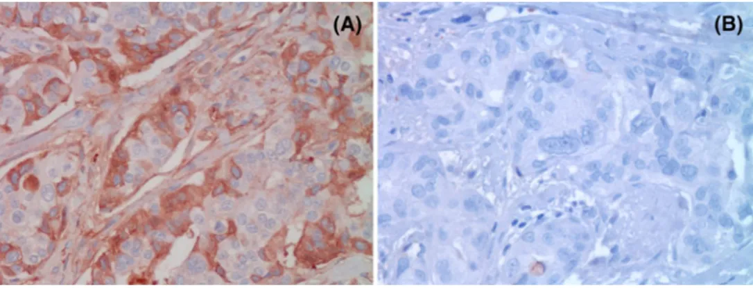 Fig. 1 a PTP1B staining of a primary invasive ductal breast cancer with cytoplasmic staining of 50 % of cells (PTP1B, 9400), b invasive ductal breast cancer negative for PTP1B staining (PTP1B, 9400)