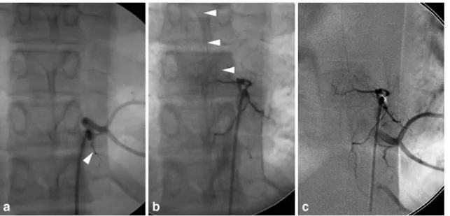 Fig. 2 A 26-year-old man with a “ complete ” form of common intercostal trunk. Selective injection at T12 opacifies both the T12 and T11 intercostal arteries, both of which have a corresponding dorsospinal branch