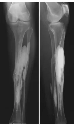 Fig. 2 Preoperative AP and lateral radiograph of the left lower leg showing a large radiopaque mass in the middle third of the leg