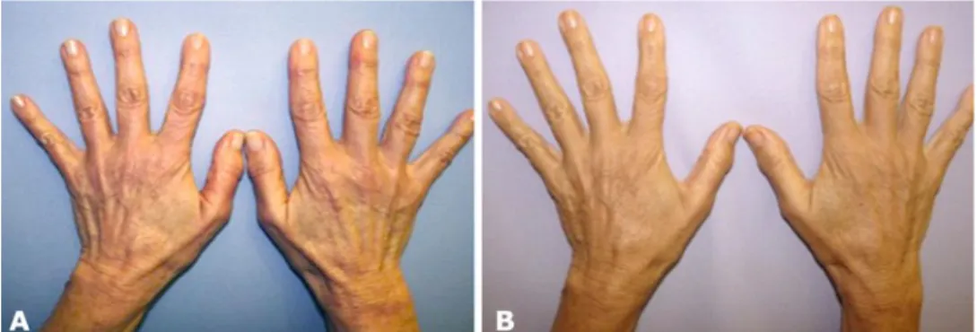 Fig. 4 58-year-old patient before (a) and 6 months after HA injection (b)