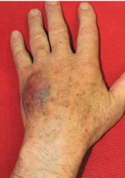 Fig. 7 Mild ecchymosis occurring after HA injection at the level of the second and third intermetacarpal spaces