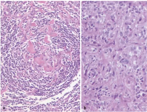 Abb. 1  8  a, b M. Castleman mit herdförmiger Vermehrung der follikulär-dendritischen Zellen in den  Lymphknoten