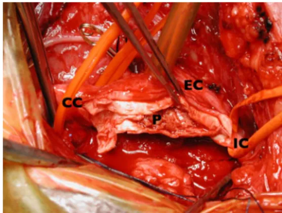Fig. 1 Intraoperative situs of endarterectomy. The common carotid artery (CC) is cross-clamped