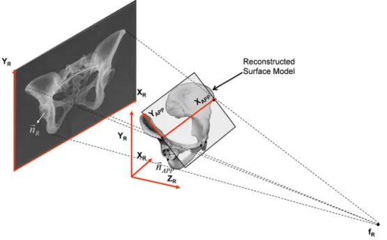 FIGURE 1. Schematic representation of using a surface model that is reconstructed from a single standard AP X-ray radiograph for estimating the post-operative cup orientation.