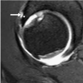 Fig. 4 A 32-year-old woman with a labral tear and paralabral cyst.