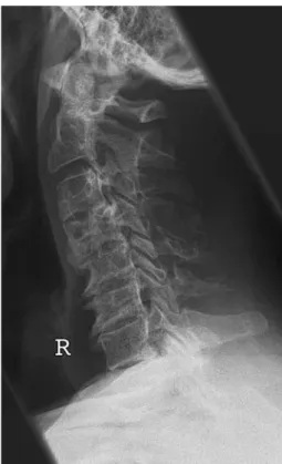 Fig. 5 Lateral view of the cervical region after 6 months still showing expansion and cystic degeneration of the fourth cervical vertebra