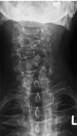 Table 1 Reported cases of Wbrous dysplasia of the cervical spine