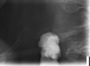 Fig. 4 Panoramic radiograph of a 67-year-old male patient showing a nodular mass adjacent to the cervical vertebrae at intervertebral space C3 – 4 besides multiple dental findings