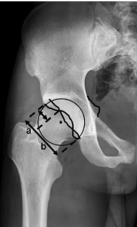 Fig. 2 Axial CT scan at the level of maximum femoral head diameter:
