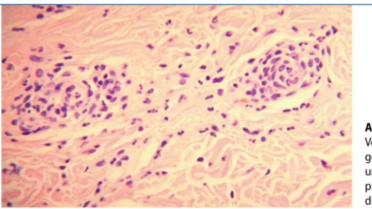 Abb. 2  9  Postkapilläre  Venolen im Korium  zei-gen eine Schwellung  und sind von  neutro-philen Granulozyten  durchsetzt